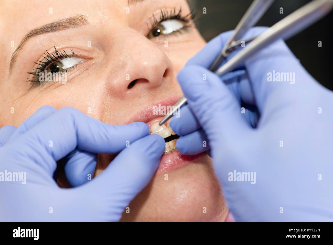 Orthodontist tightening braces Stock Photo Alamy