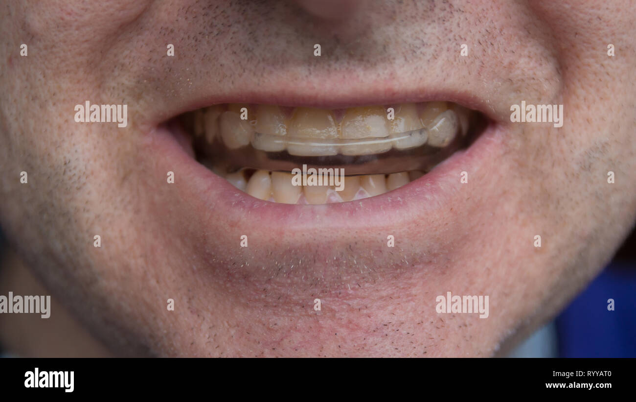 Tooth erosion hi-res stock photography and images - Alamy