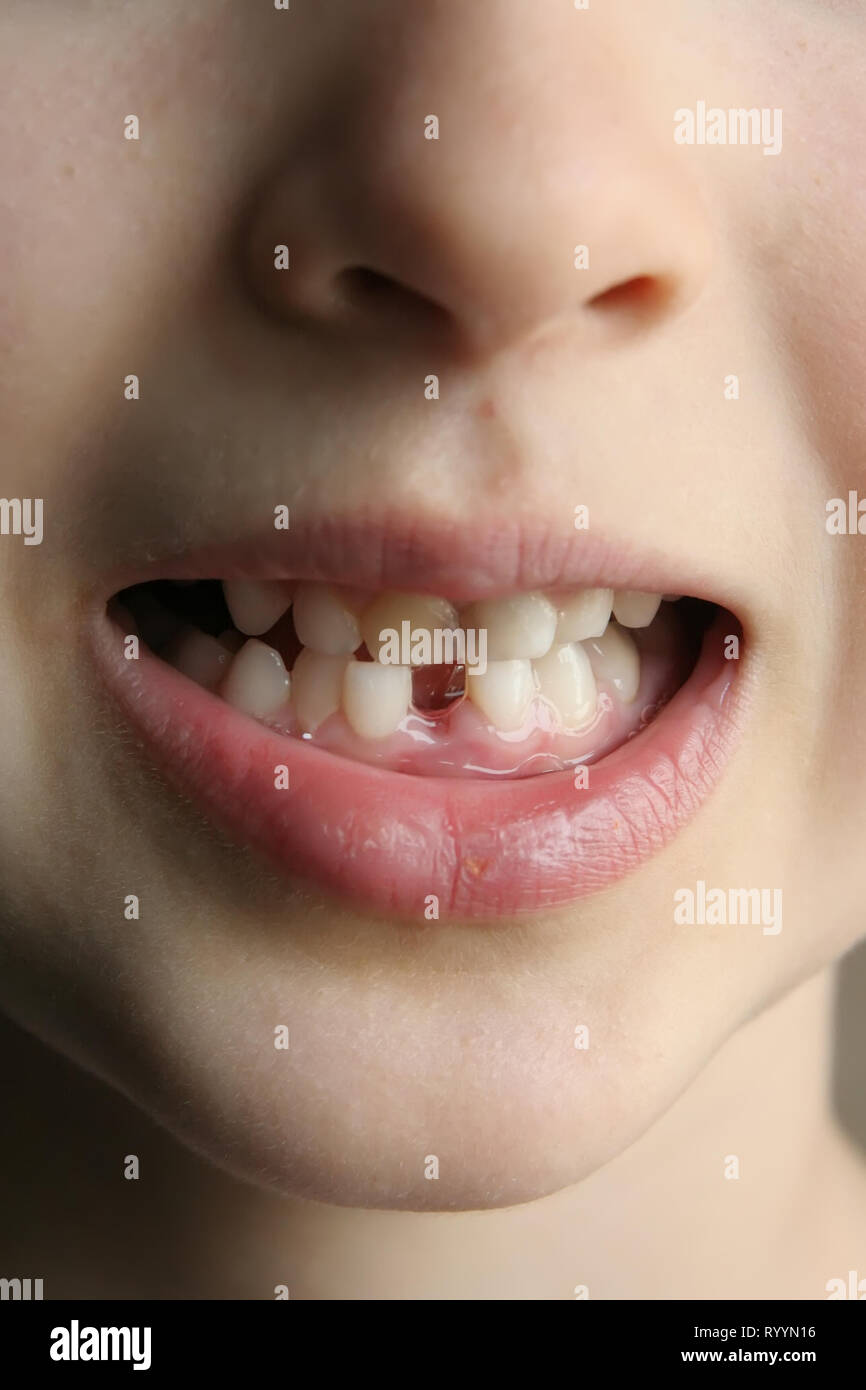 Child missing tooth. Kid missing one tooth. Gap between kids teeth. Stock Photo