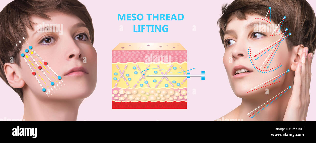 Meso thread Lift. Young female with clean fresh skin. Beautiful woman