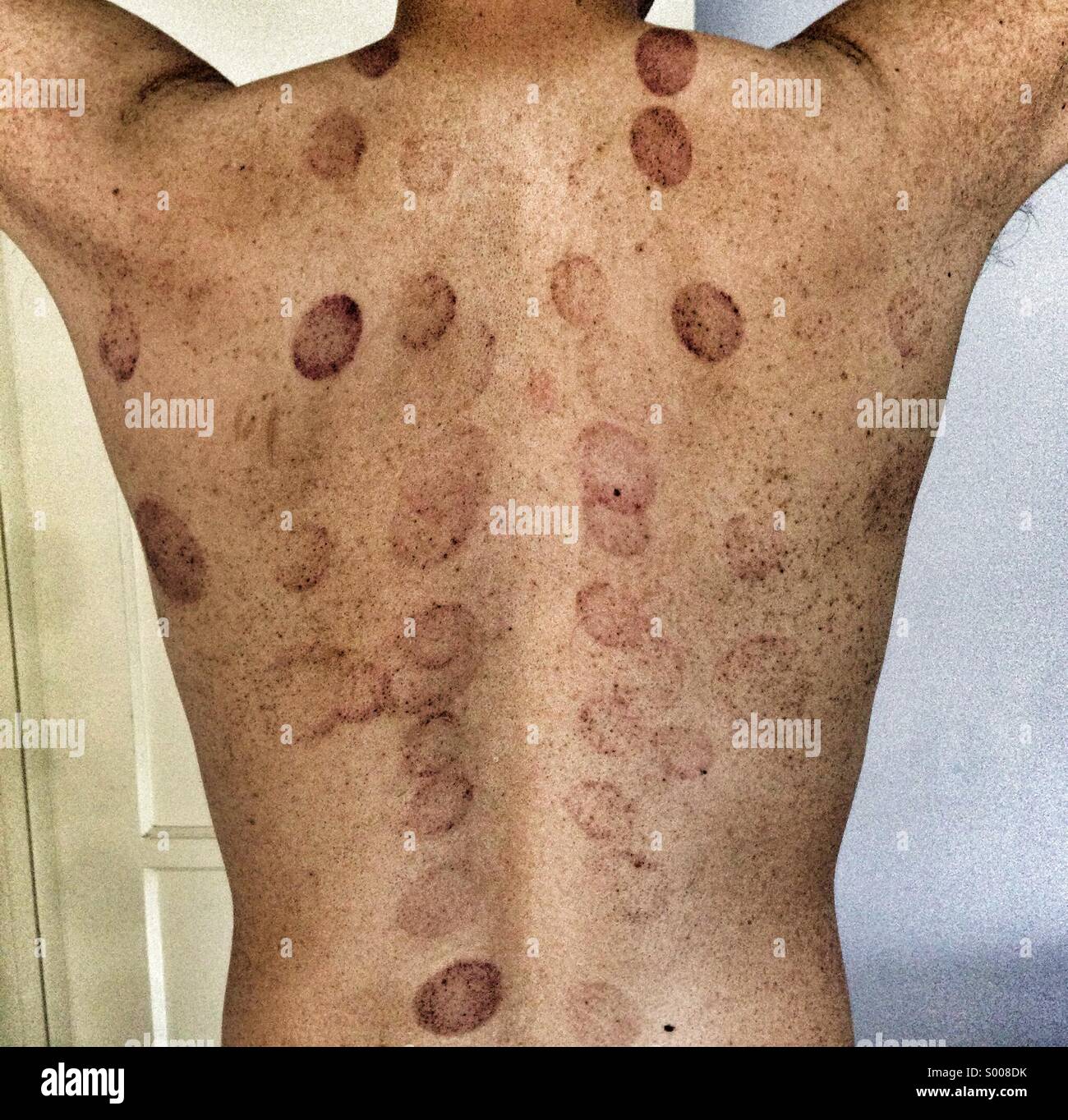 Bad Bruises On Back