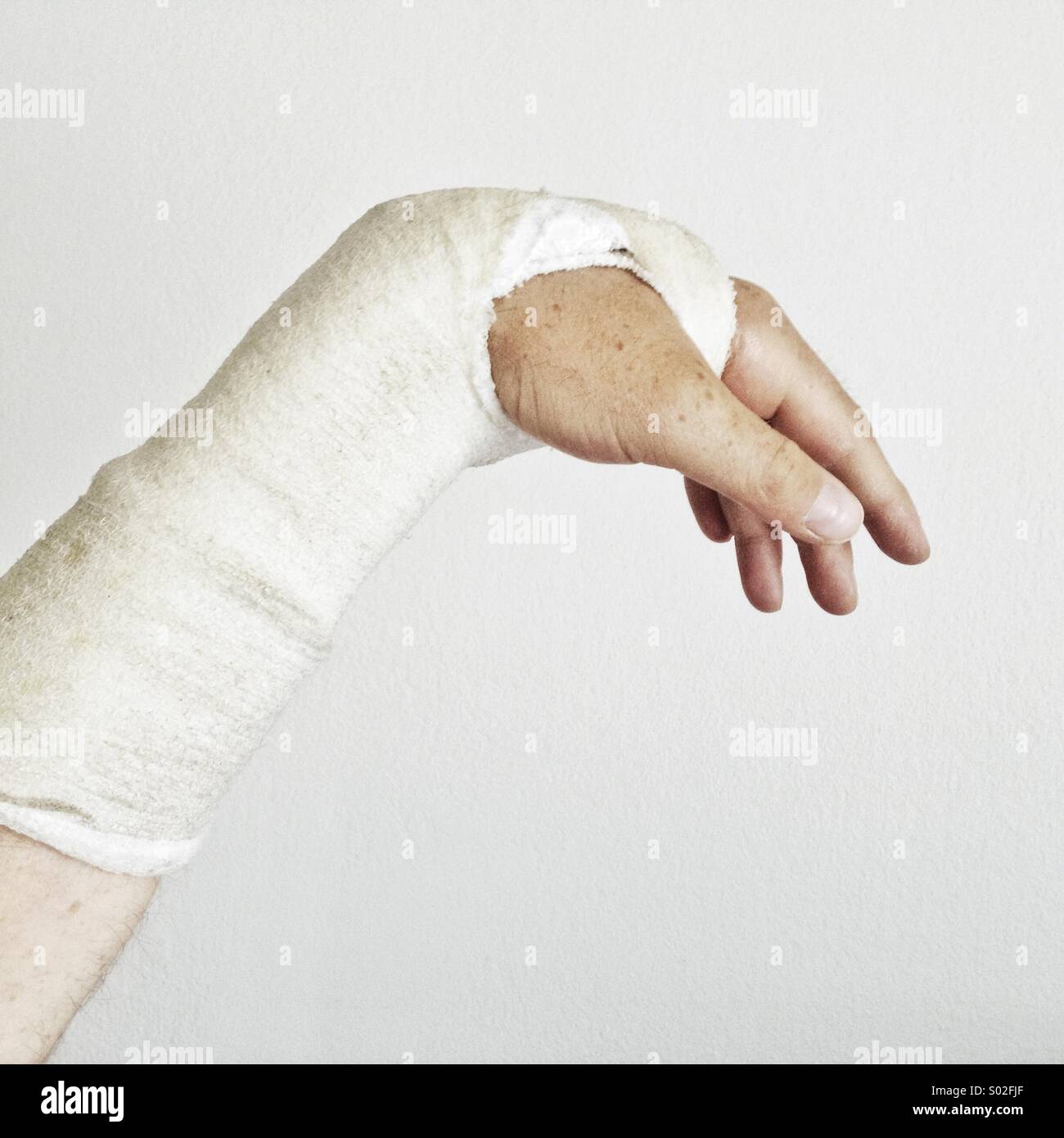 Broken wrist with a plaster cast. Stock Photo