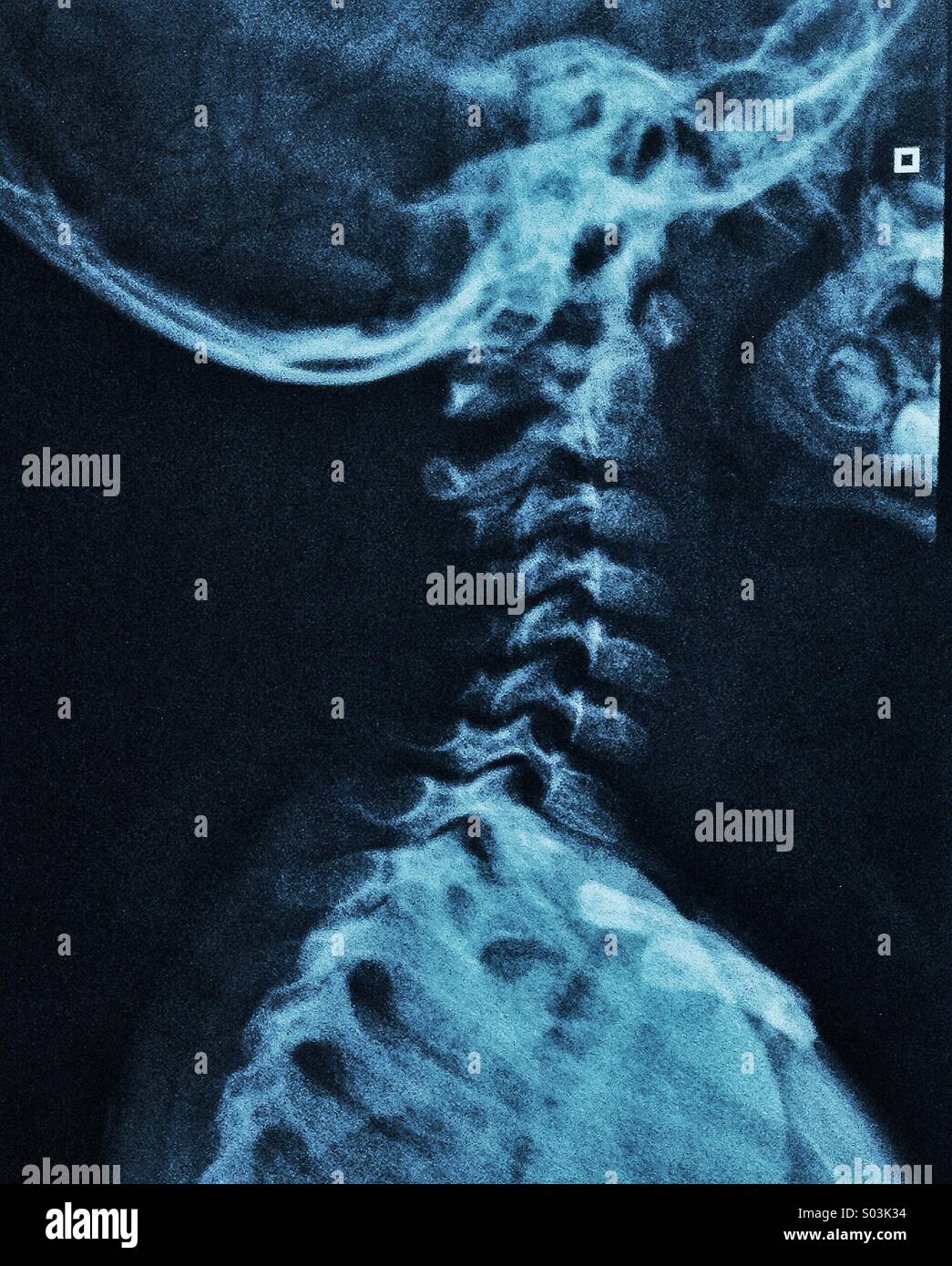 Radiography of head - Smartphone Captured Stock Image