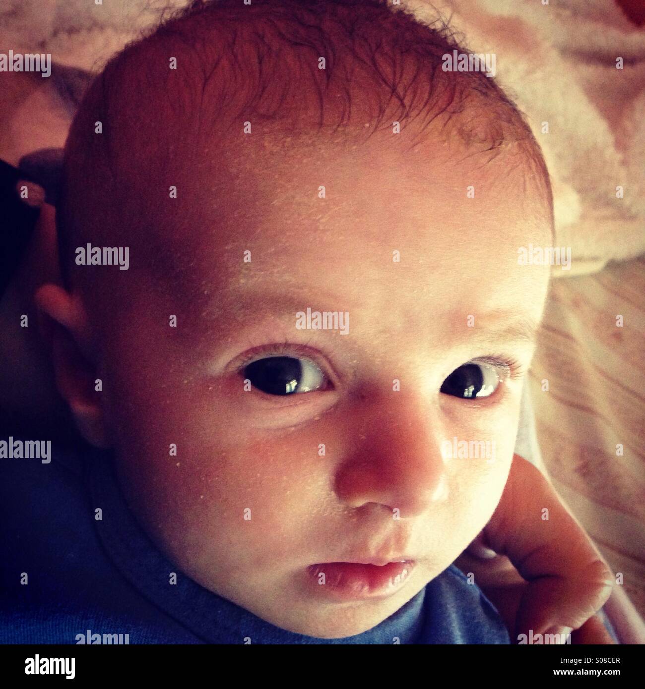 Eczema baby face hires stock photography and images Alamy