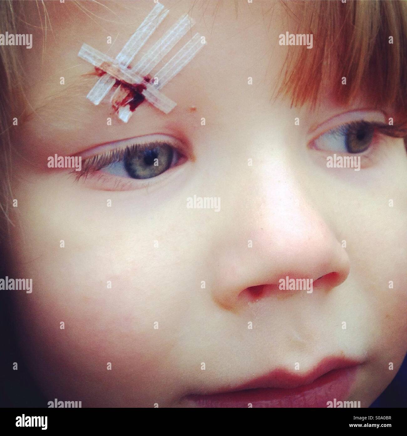 Boy with Steri-strips across a cut on his Eyebrow - Smartphone Captured Stock Image
