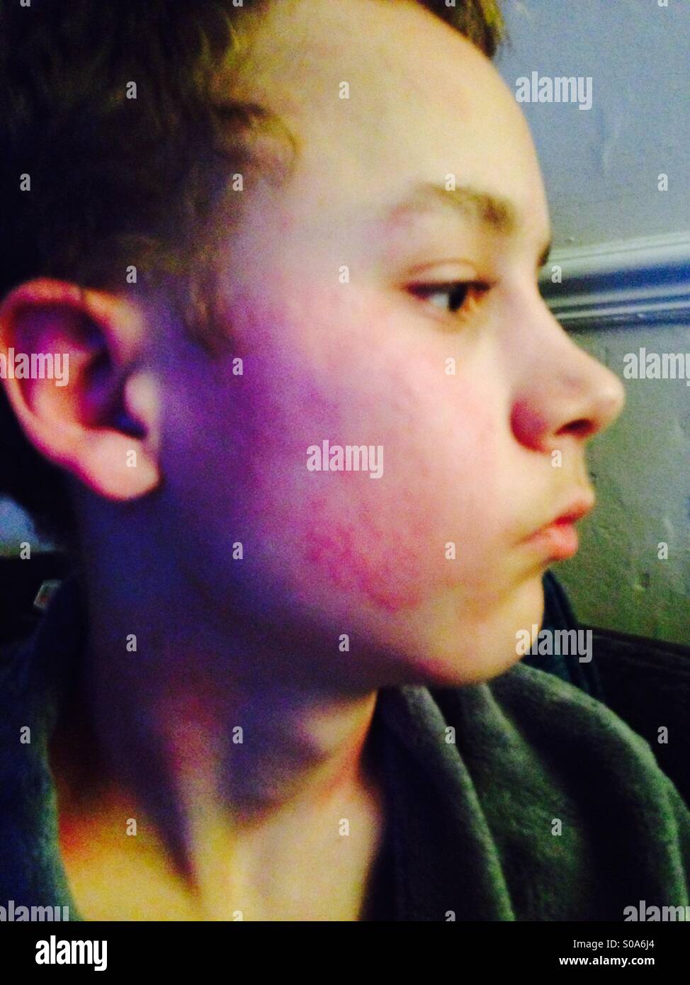 Boy with rash Stock Photo