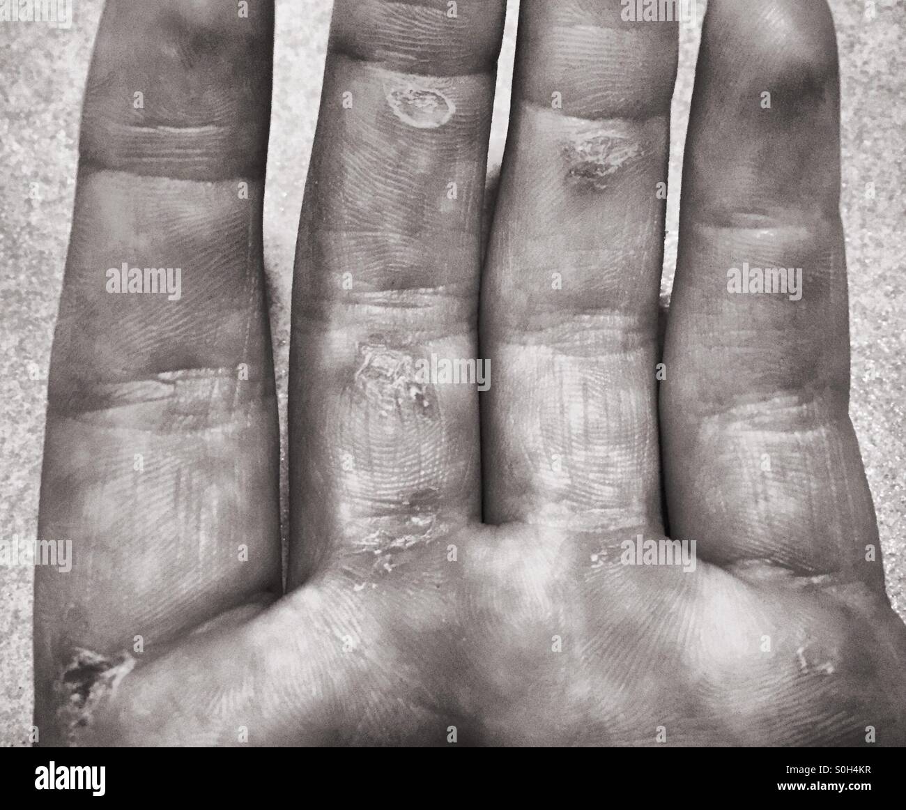 Rowing hurts hand with blisters Stock Photo Alamy