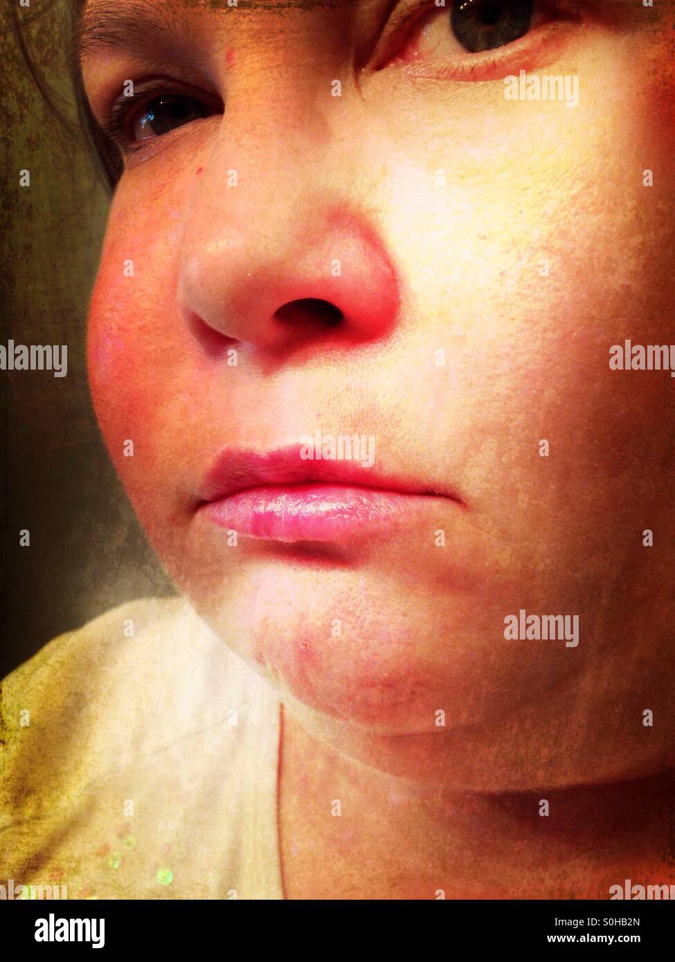 Misery: a swollen face from an abscessed tooth (2 Stock Photo - Alamy