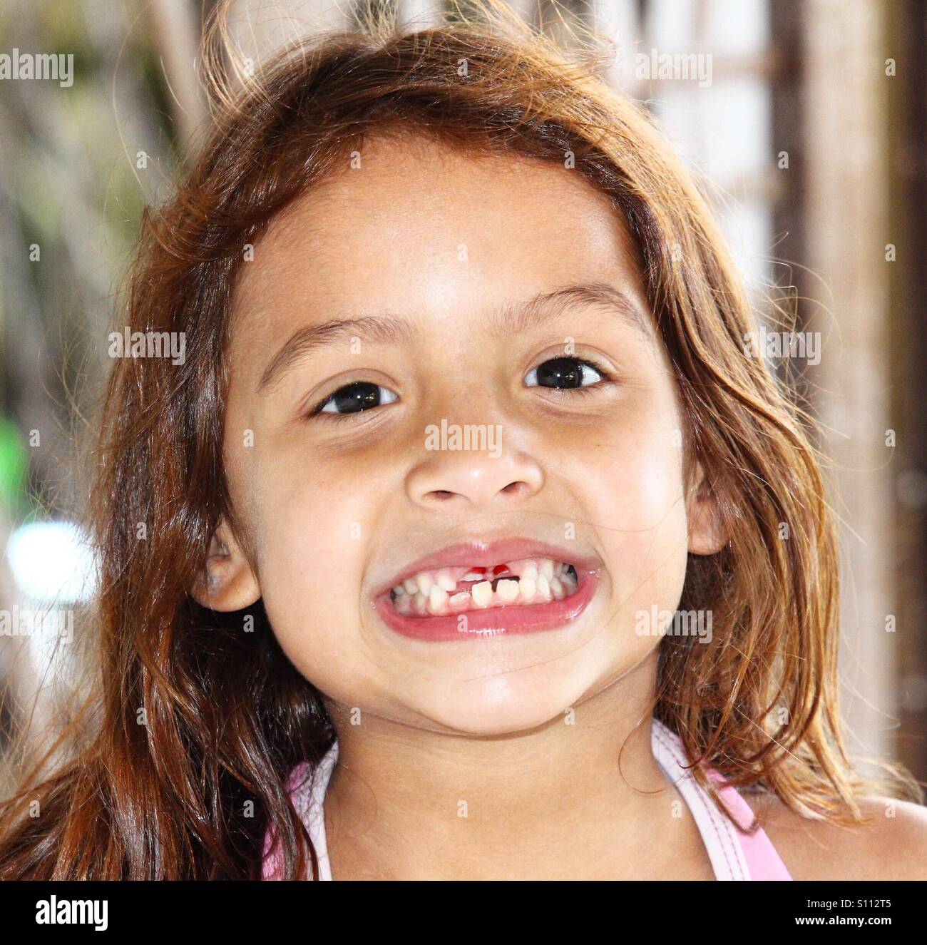 Little Girl Missing Front Tooth