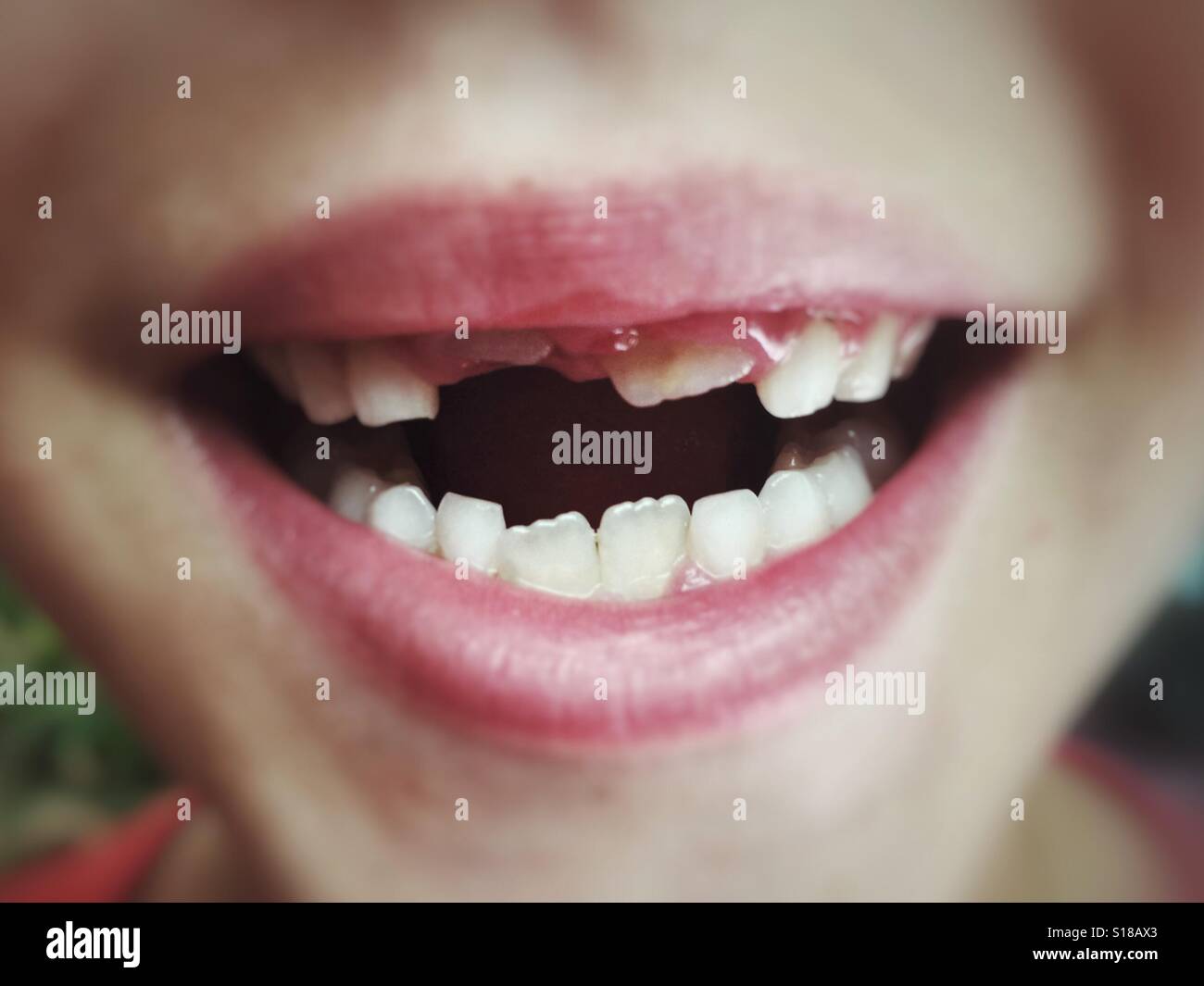 Missing teeth hi-res stock photography and images - Page 2 - Alamy