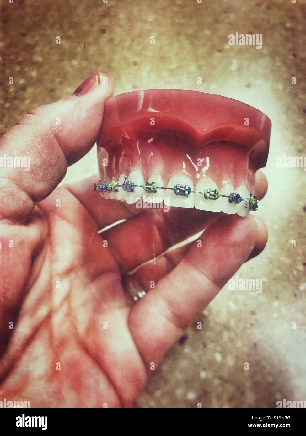 Resin cast to demonstrate teeth with braces - Smartphone Captured Stock Image