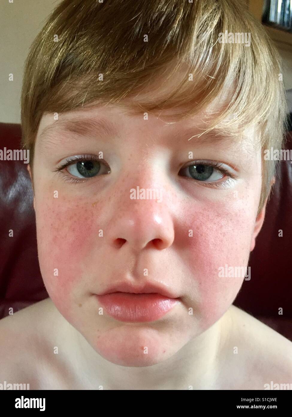 Boy with Chronic Idiopathic Urticaria. Hives Stock Photo