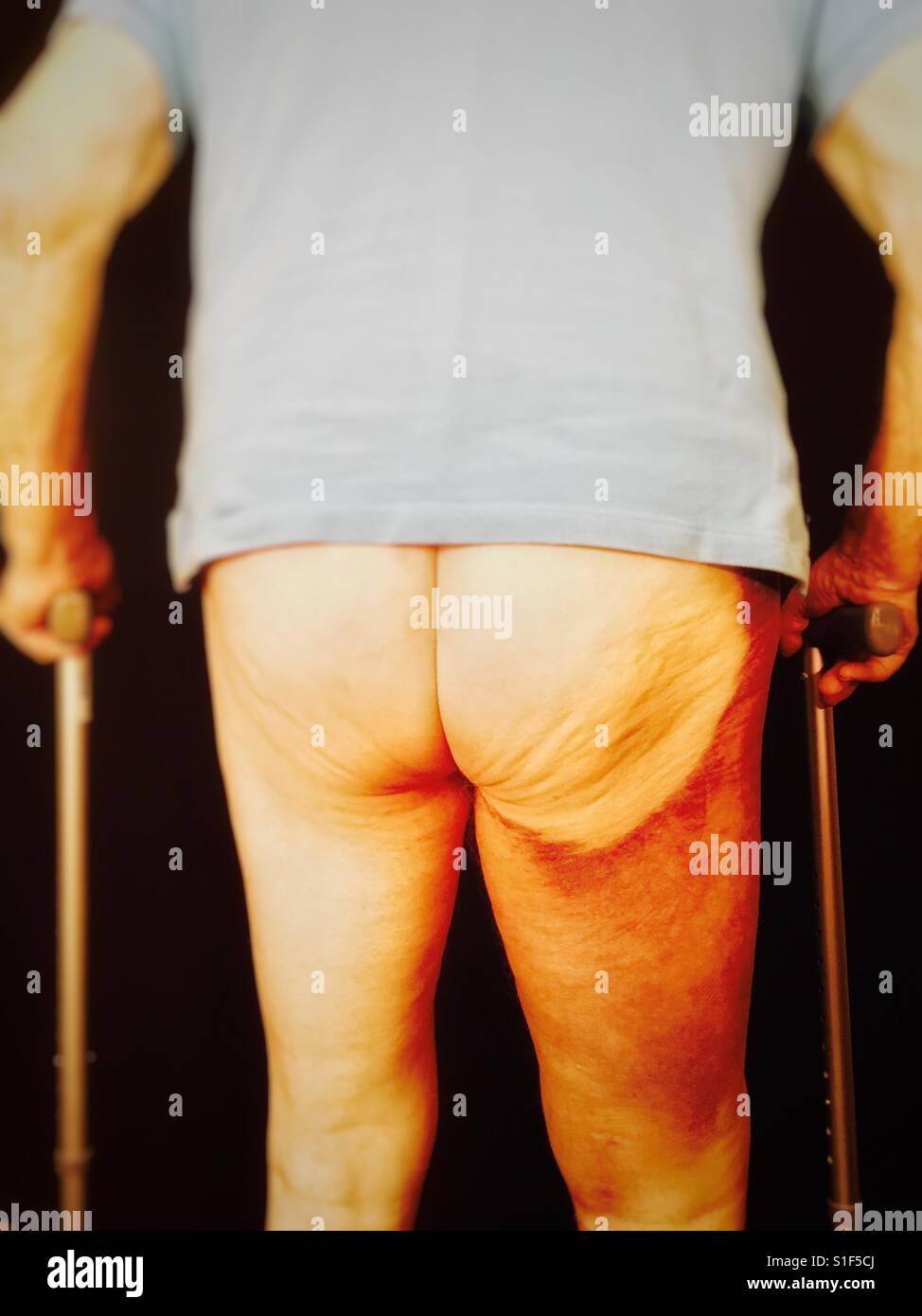 Bruising on an elderly mans leg after a knee replacement operation UK - Smartphone Captured Stock Image