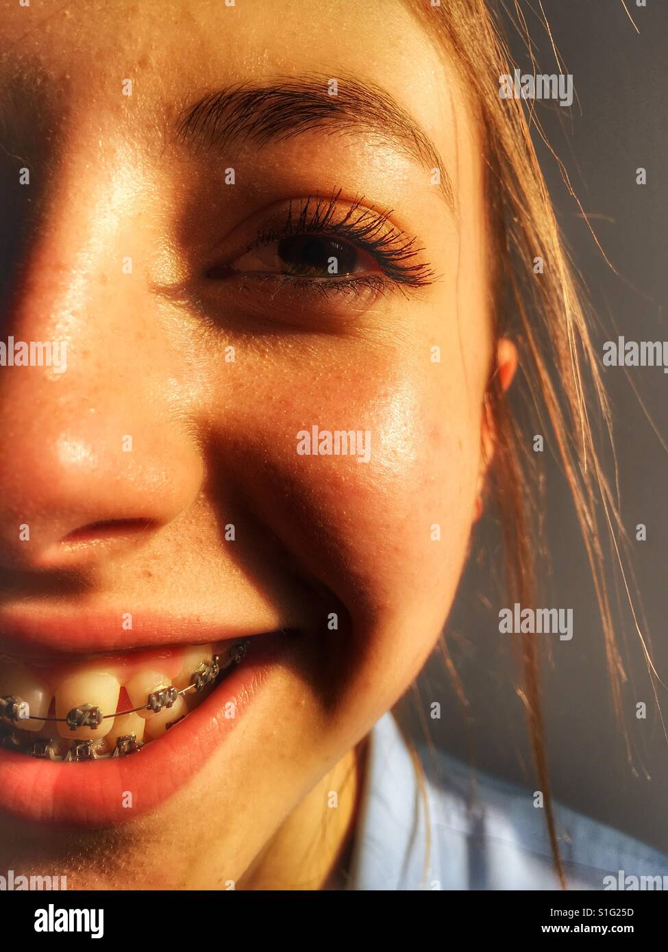 13 year old girl braces hires stock photography and images Alamy