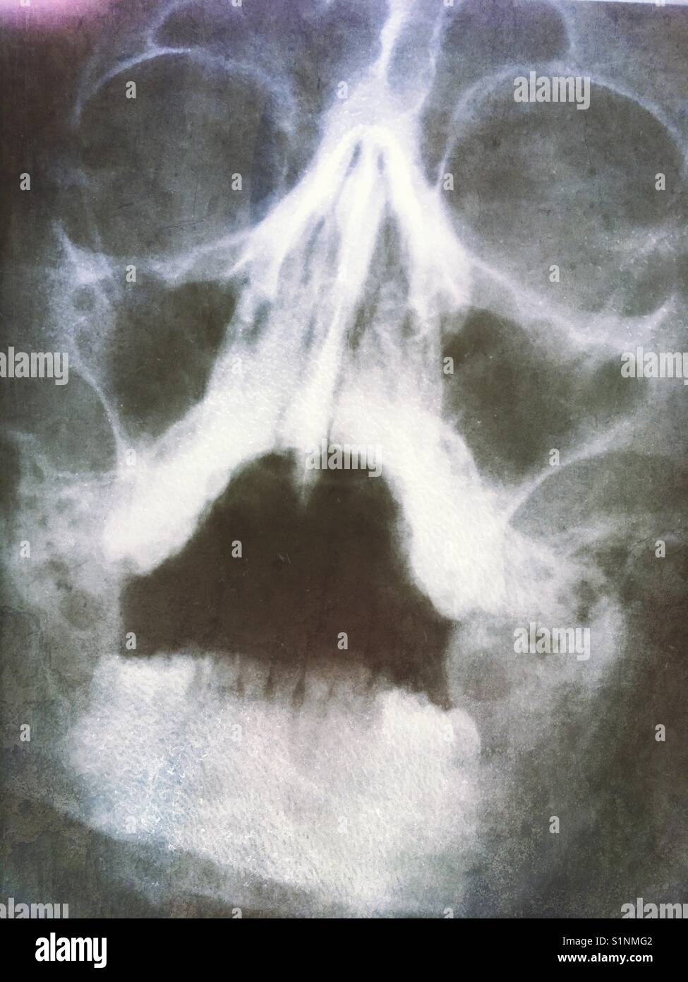 An x-ray of a human skull - Smartphone Captured Stock Image