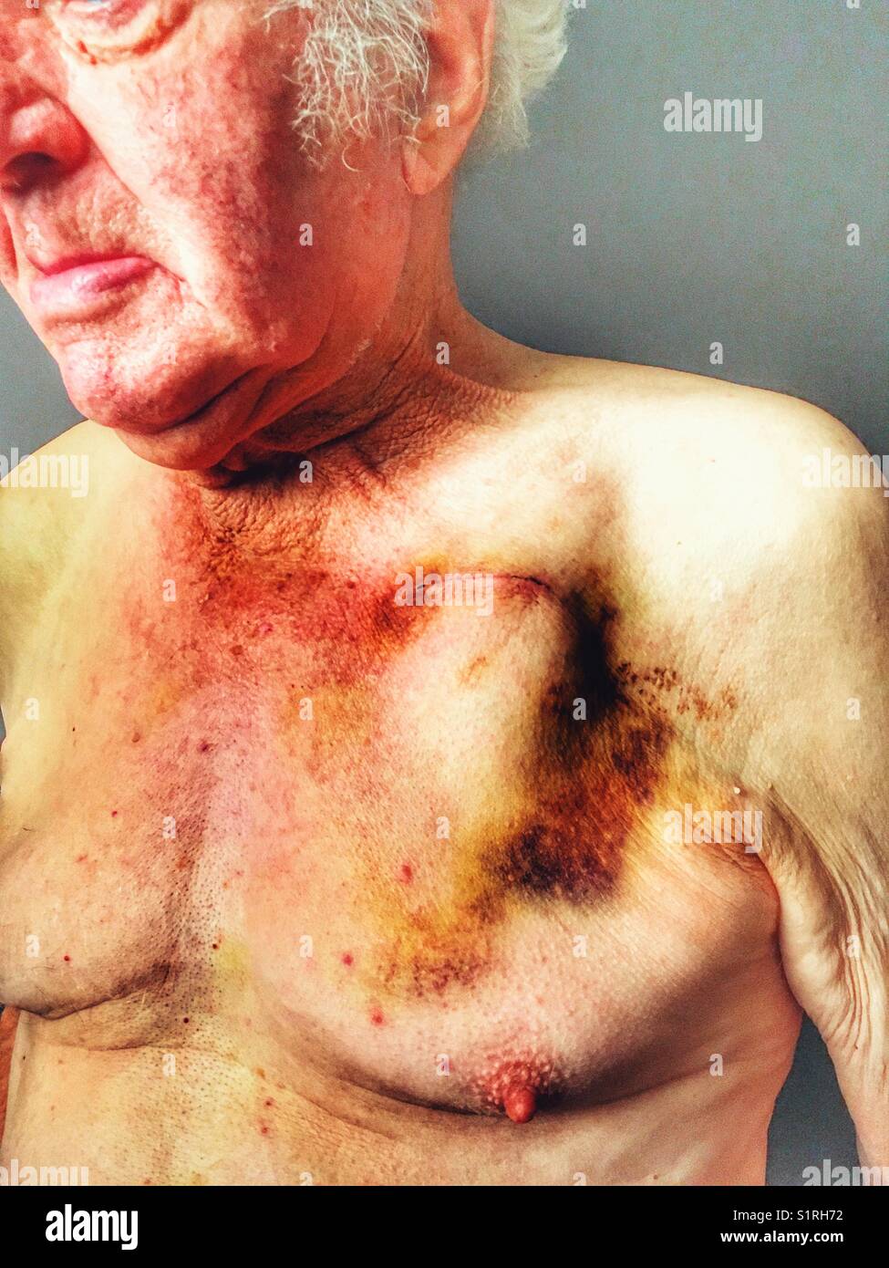 Post operation scar and bruises - Smartphone Captured Stock Image