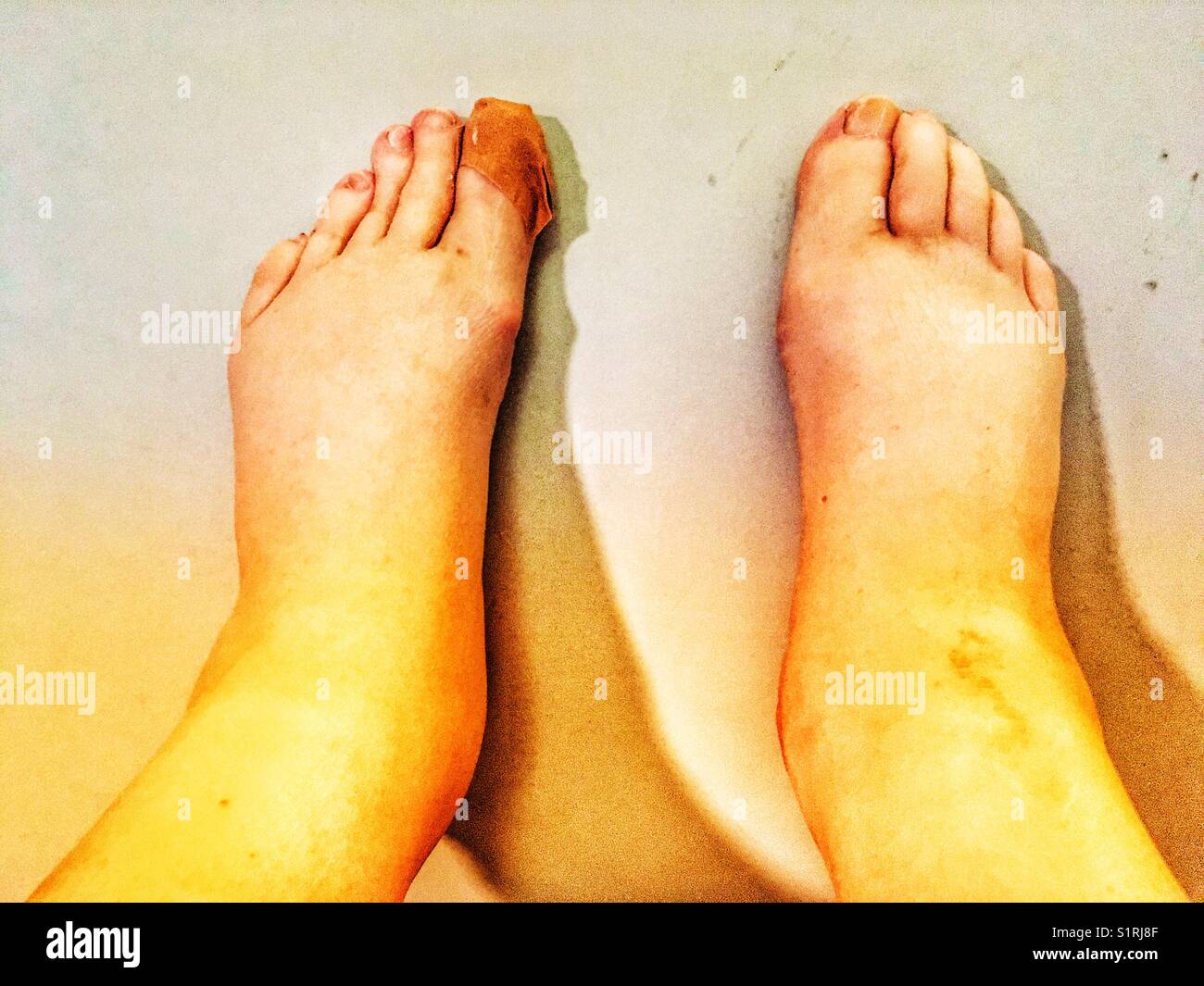Elderly man with water retention in his feet Stock Photo