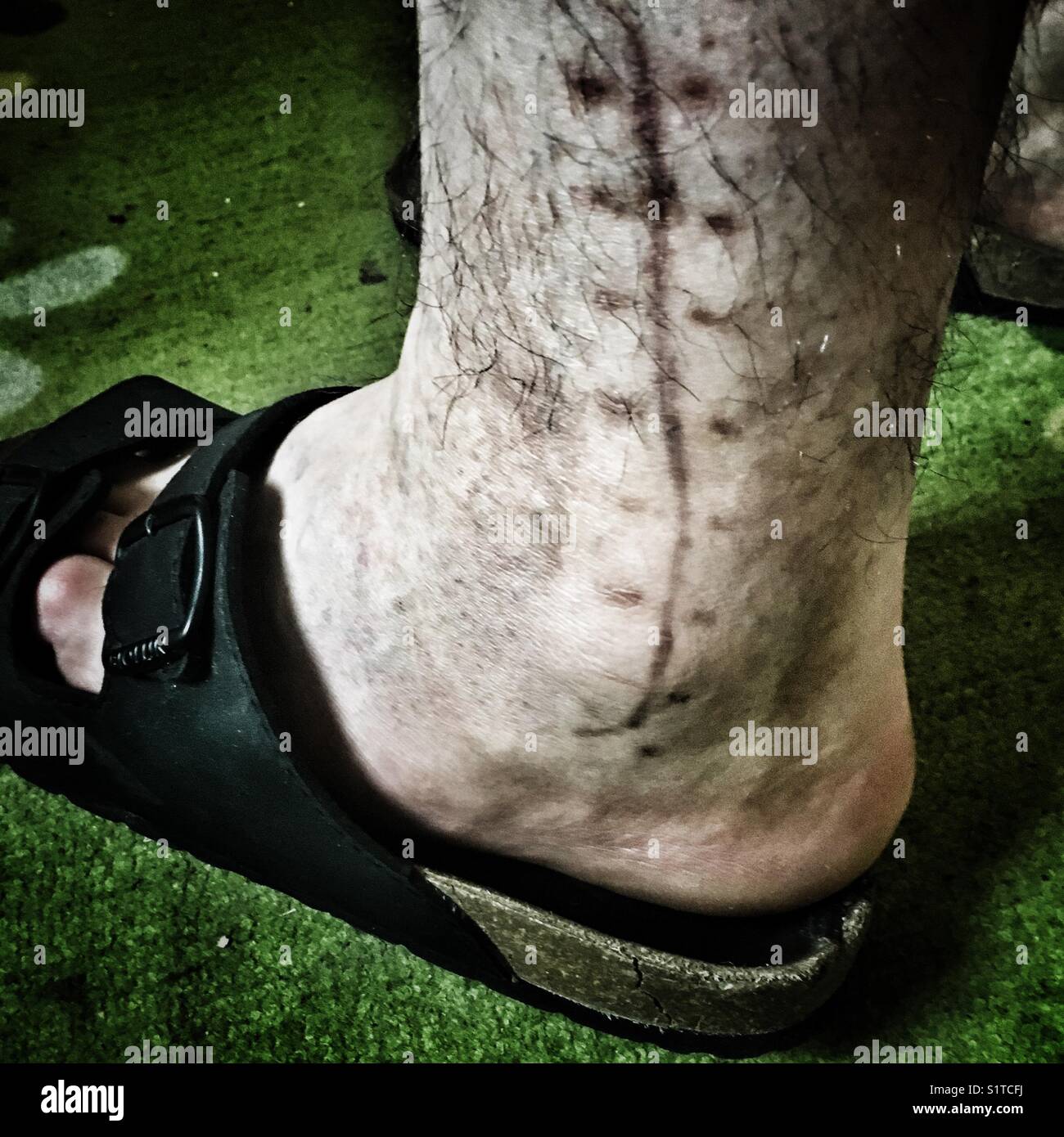 A visible long scar and stitches on the leg after the operation of the ankle Stock Photo