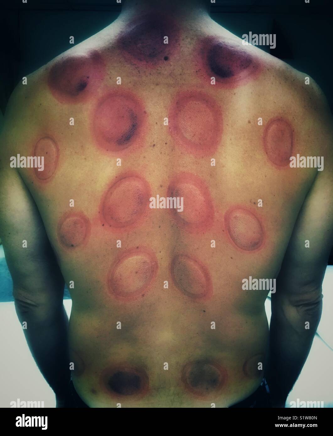 Cupping therapy welts on back Stock Photo