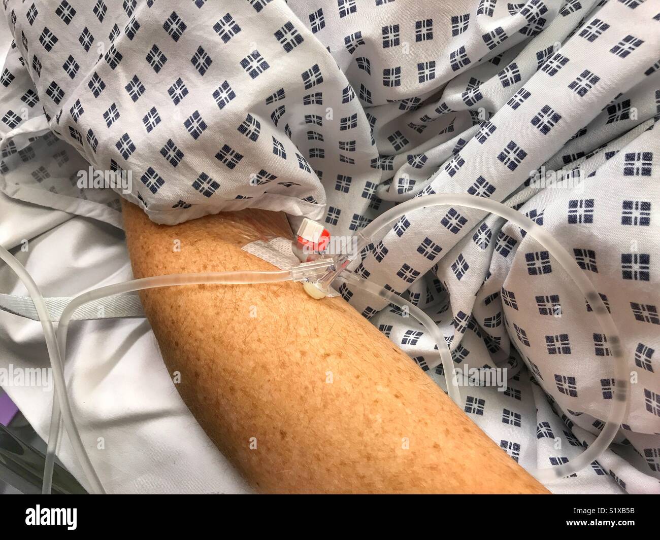 Woman’s arm with an intravenous drip, in hospital, close -up - Smartphone Captured Stock Image