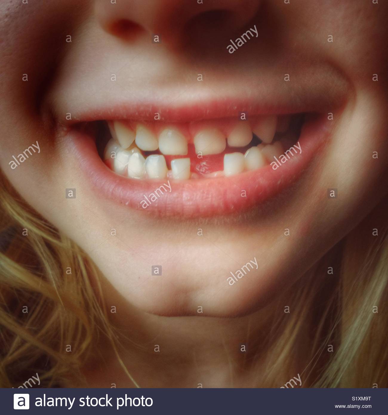 Child with missing front tooth closeup Stock Photo