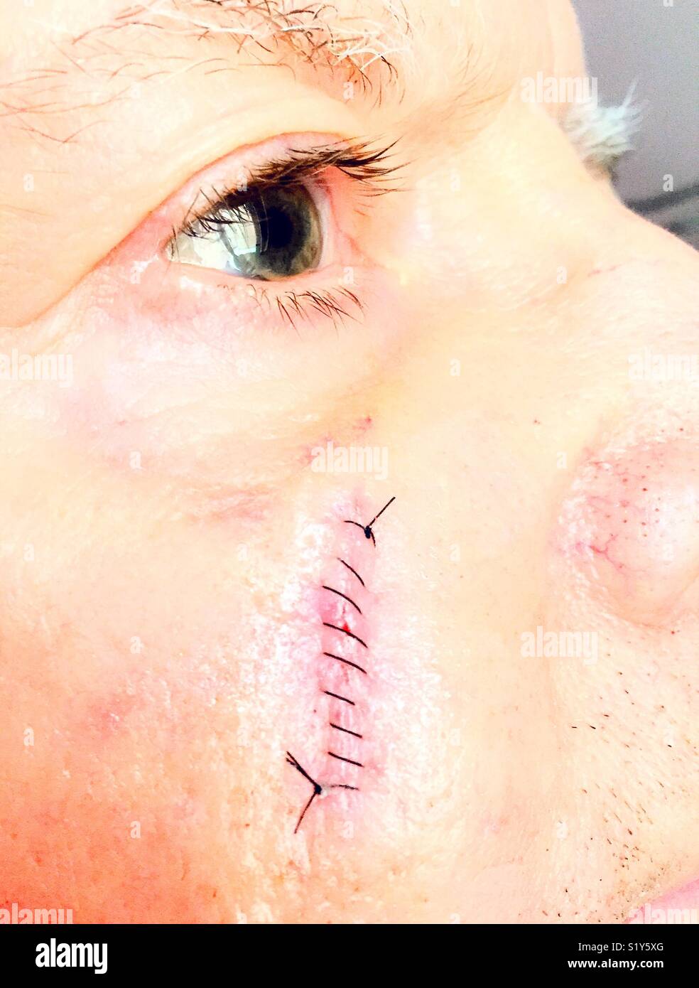 Stitches healing a wound on a man’s face. - Smartphone Captured Stock Image