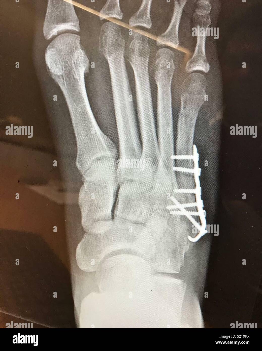 Xray right foot Stock Photo Alamy