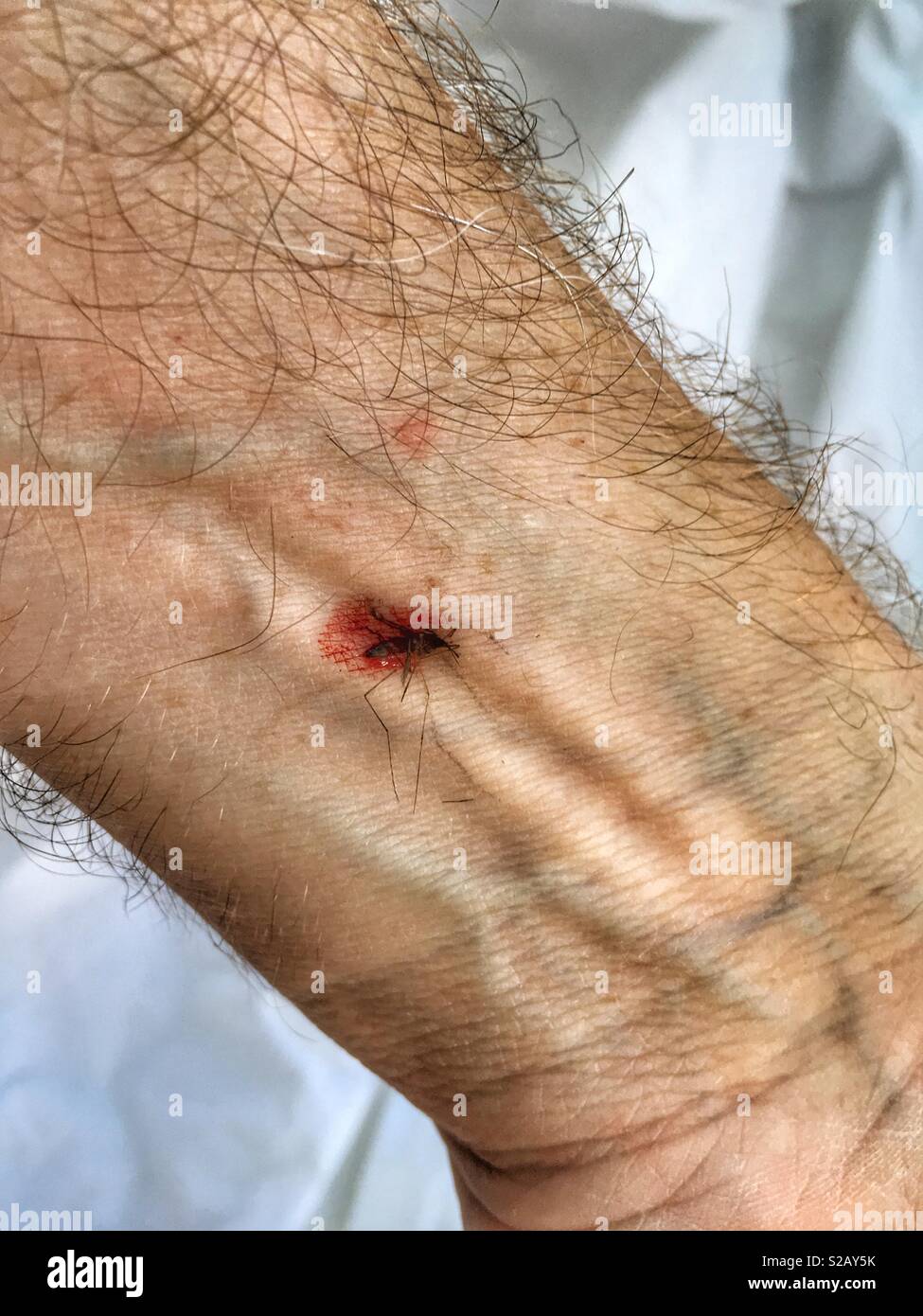 Mosquito splattered after biting man on the arm - Smartphone Captured Stock Image