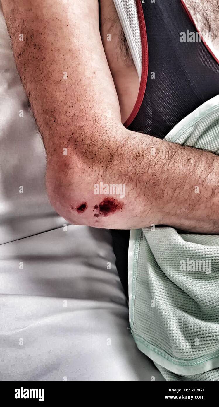 Fractured elbow hires stock photography and images Alamy