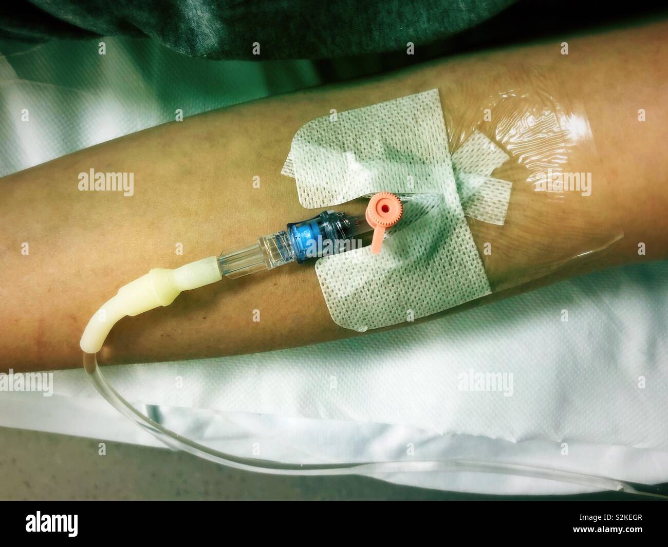 A patient's arm with an intravenous drip Stock Photo