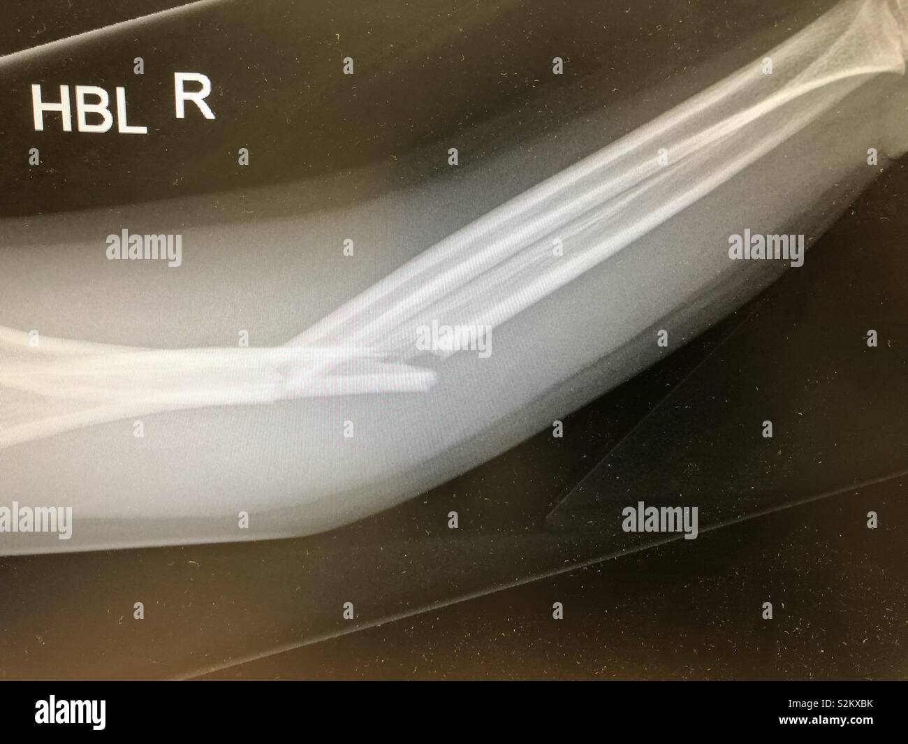 Broken arm Xray Stock Photo Alamy