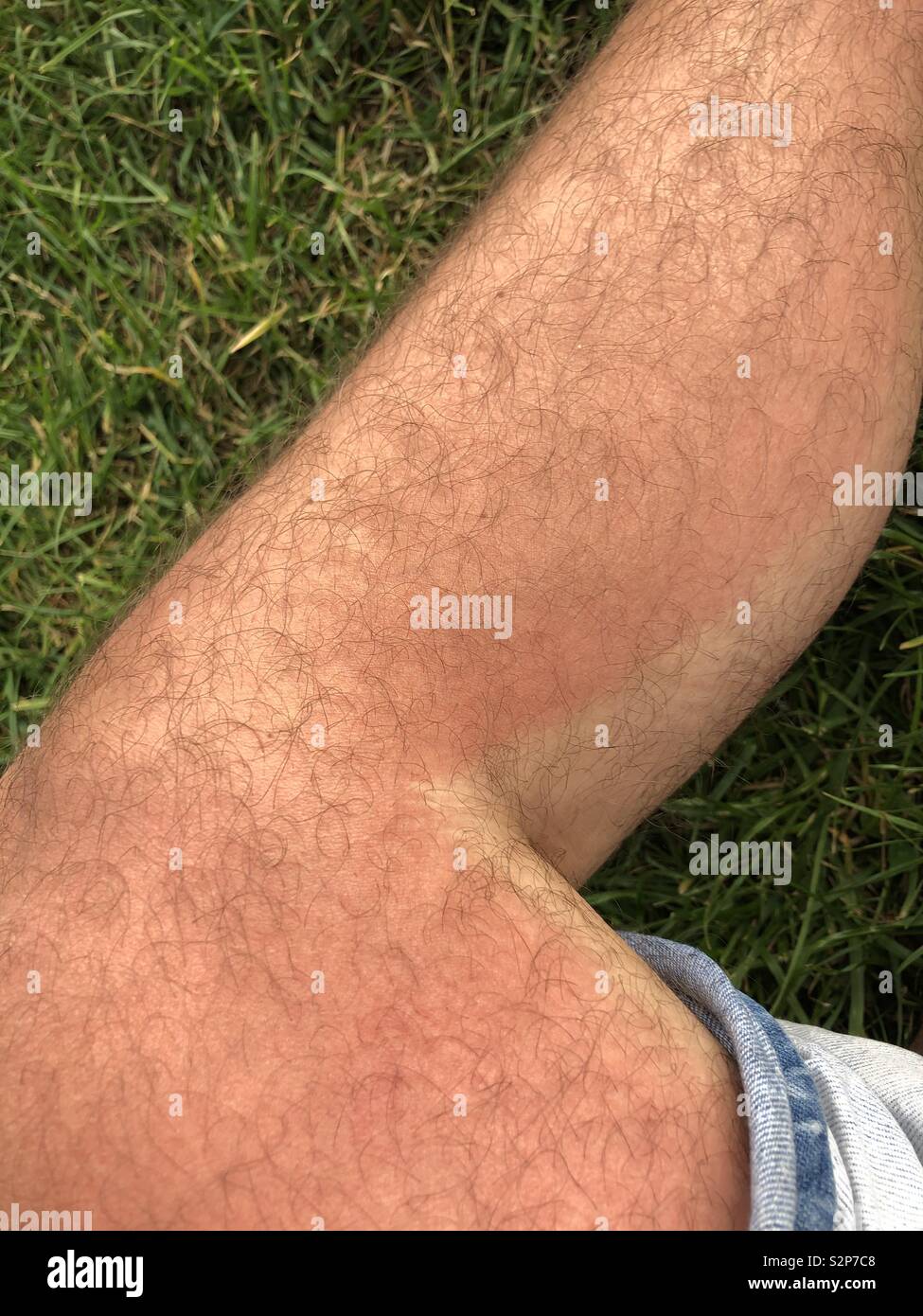 Sunburnt leg of a male Stock Photo