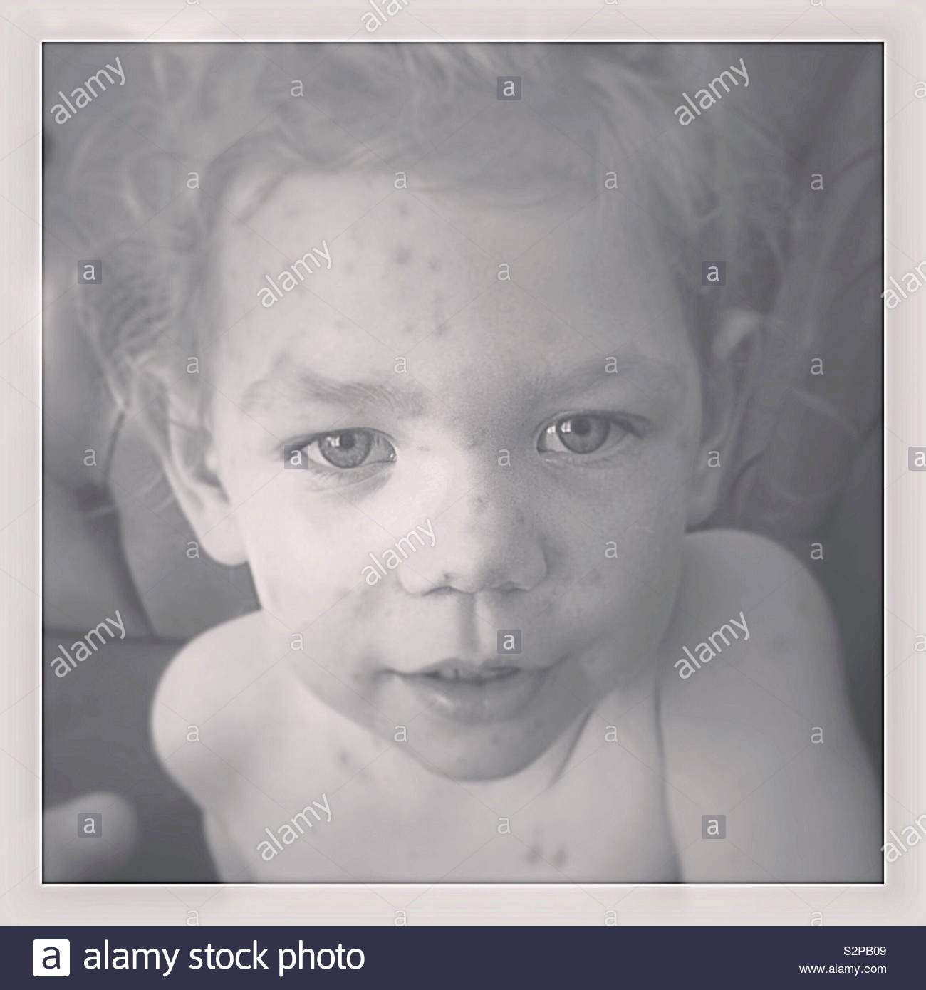 2 year old girl with chicken pox Stock Photo - Alamy