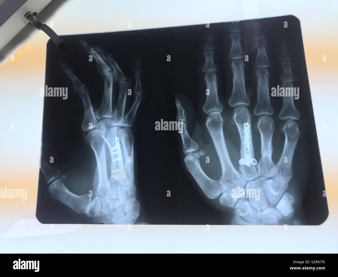 Bones of the hand ??, surgery day Stock Photo