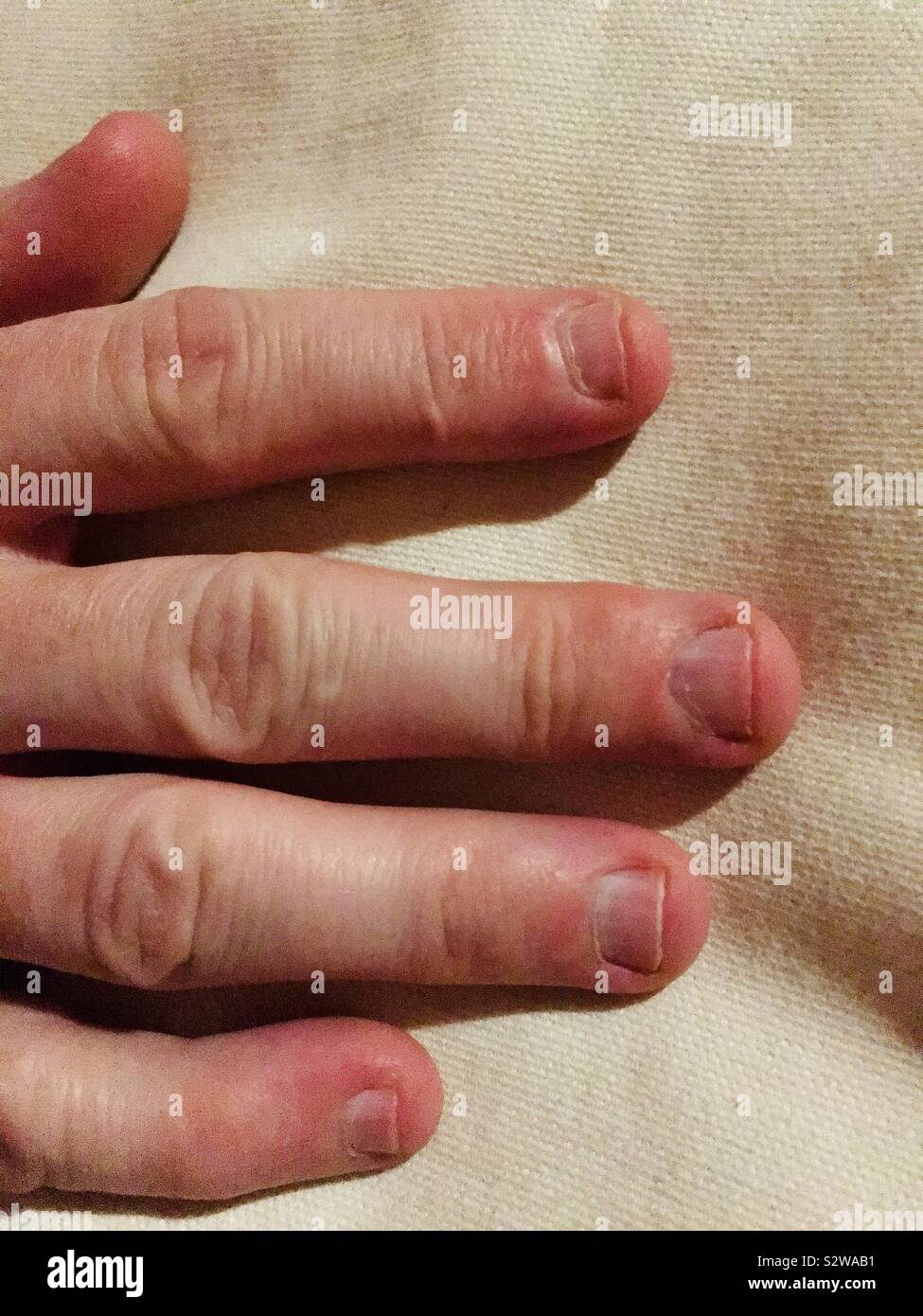 Man’s fingers with bitten fingernails Stock Photo