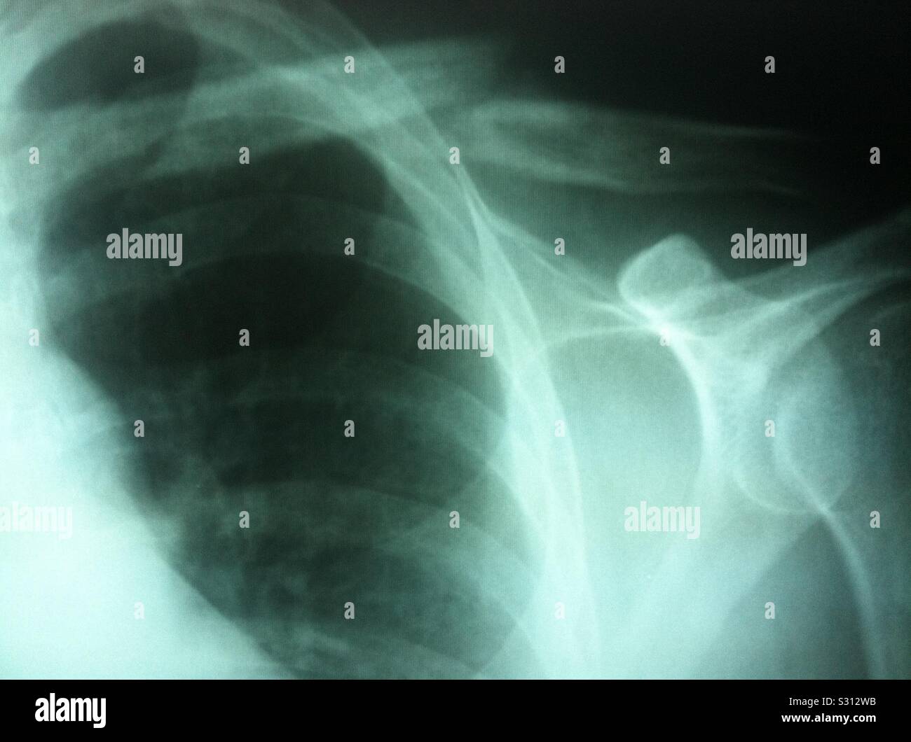 X-Ray image of broken left collarbone. Stock Photo