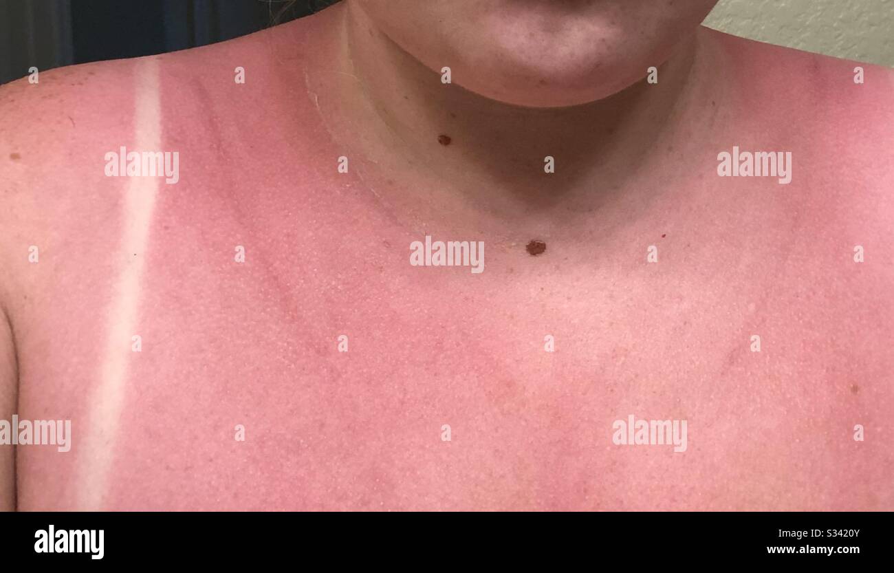 Sunburn on shoulders Stock Photo Alamy