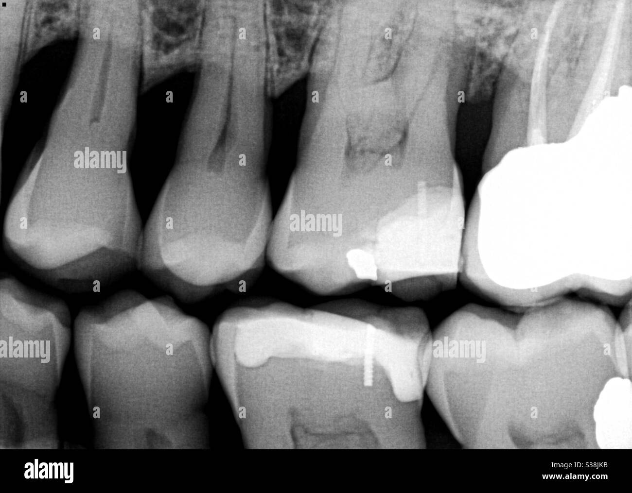 Root canal and several cavities Stock Photo Alamy