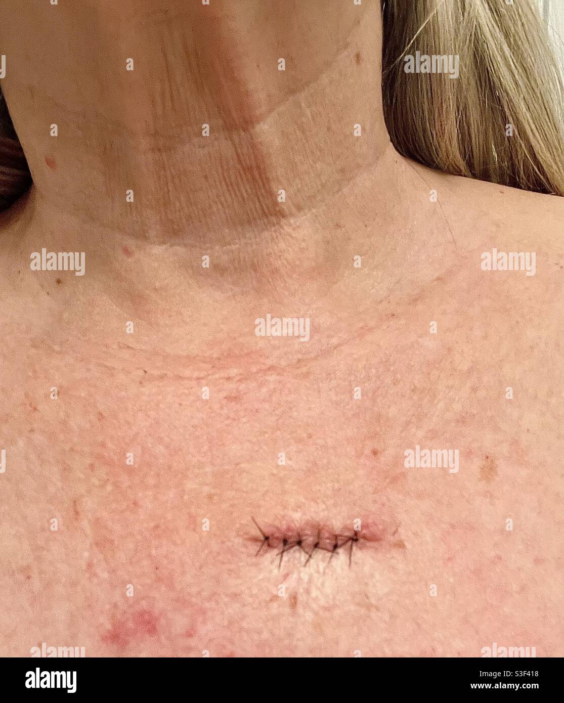 Stitches removal hires stock photography and images Alamy