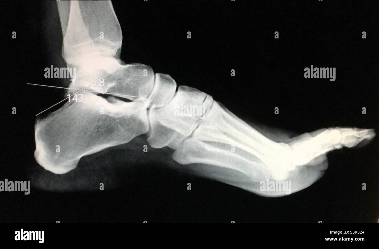 X day of a foot and ankle - Smartphone Captured Stock Image