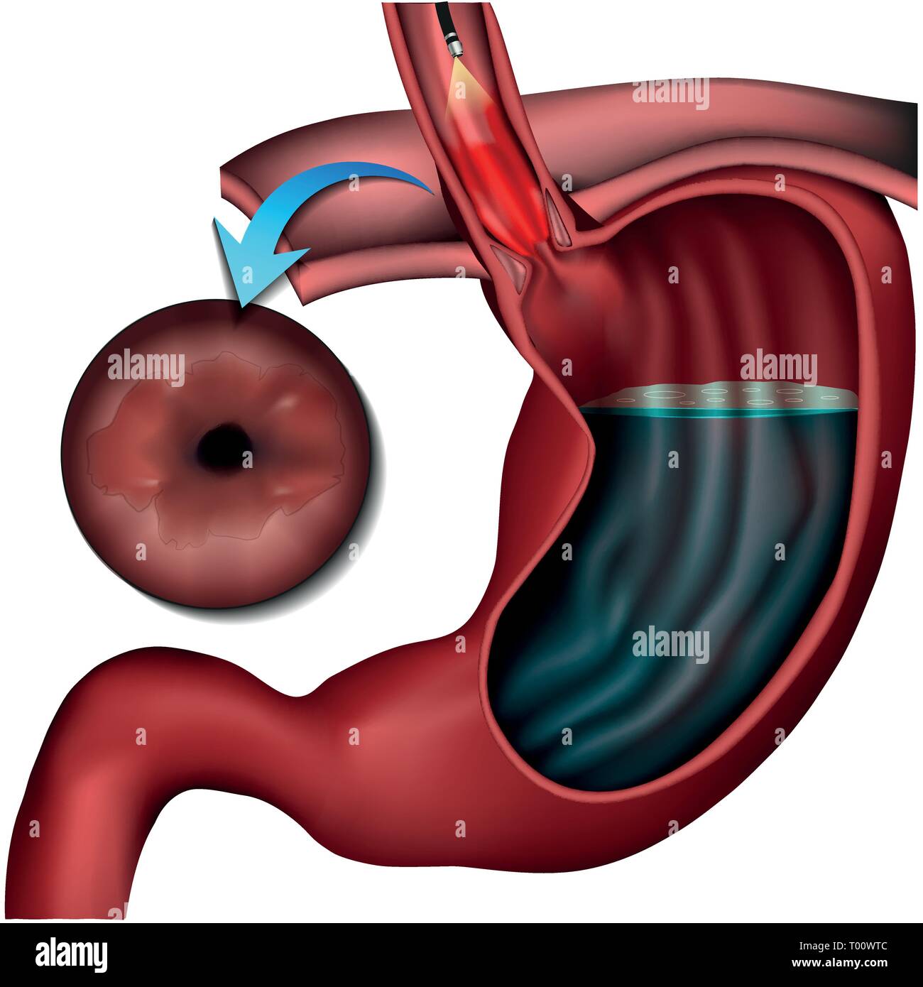 Barett esophagus disease medical vector illustration on white background Stock Vector