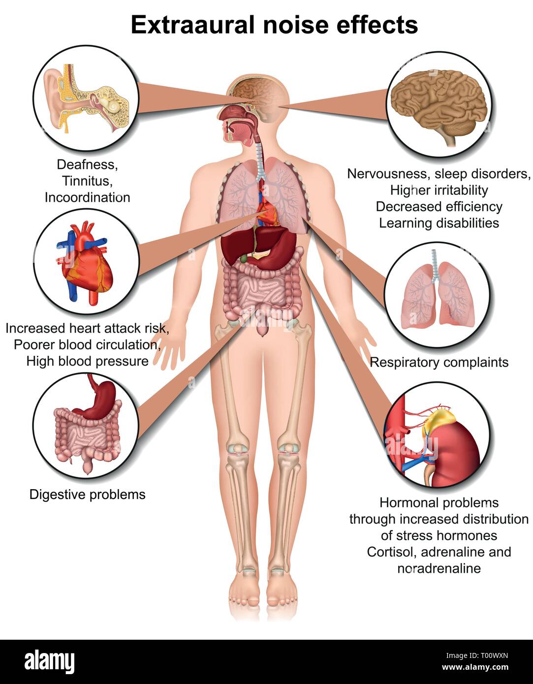 Extraaural health effects of chronic noise exposure medical vector