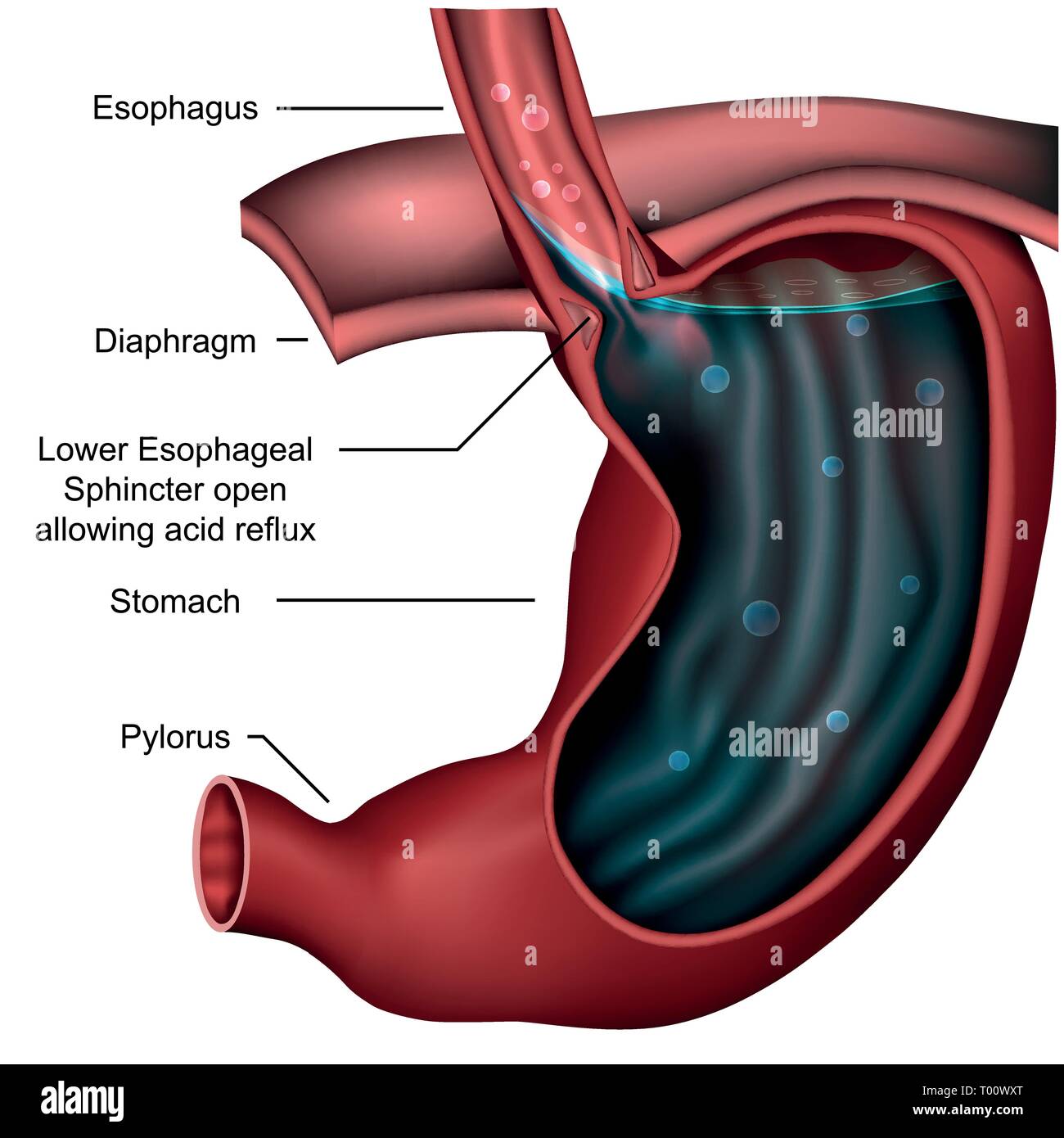 Esophagealsphincter anatomy Reflux 3d medical vector illustration Stock Vector