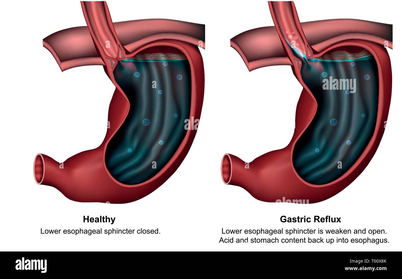 Gastric reflux 3d medical vector illustration with english description Stock Vector