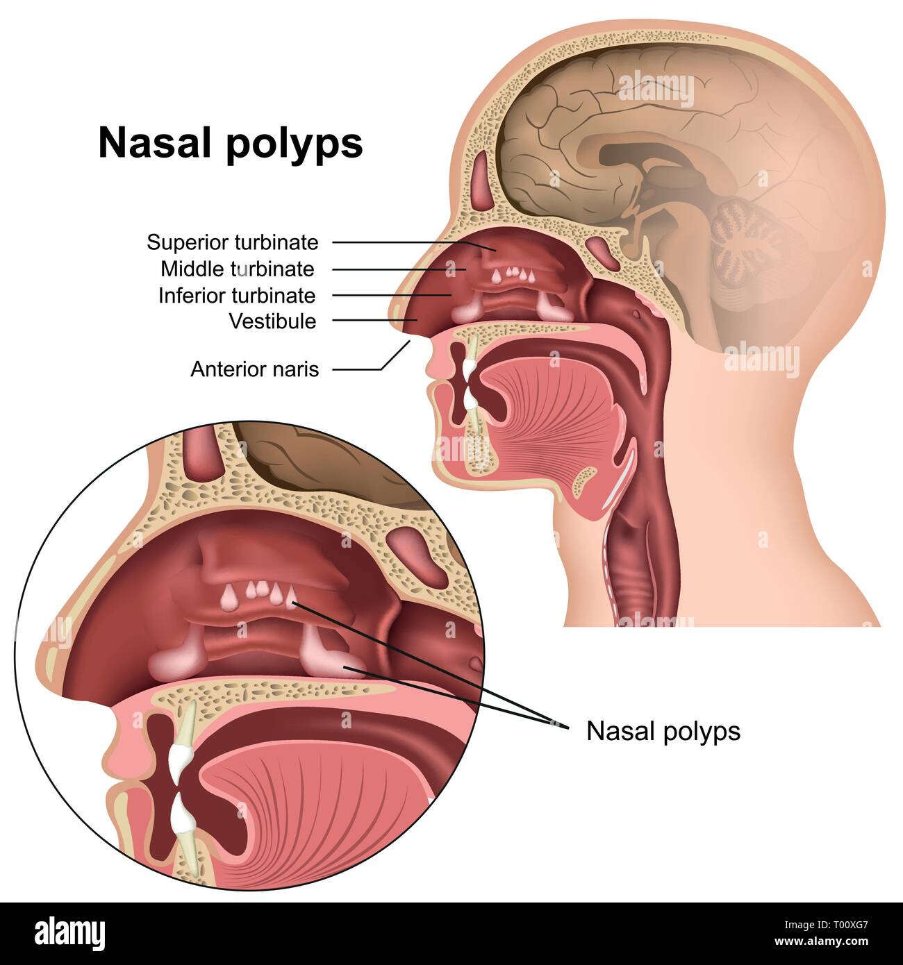 Nasal polyps medical vector illustration on white background Stock Vector