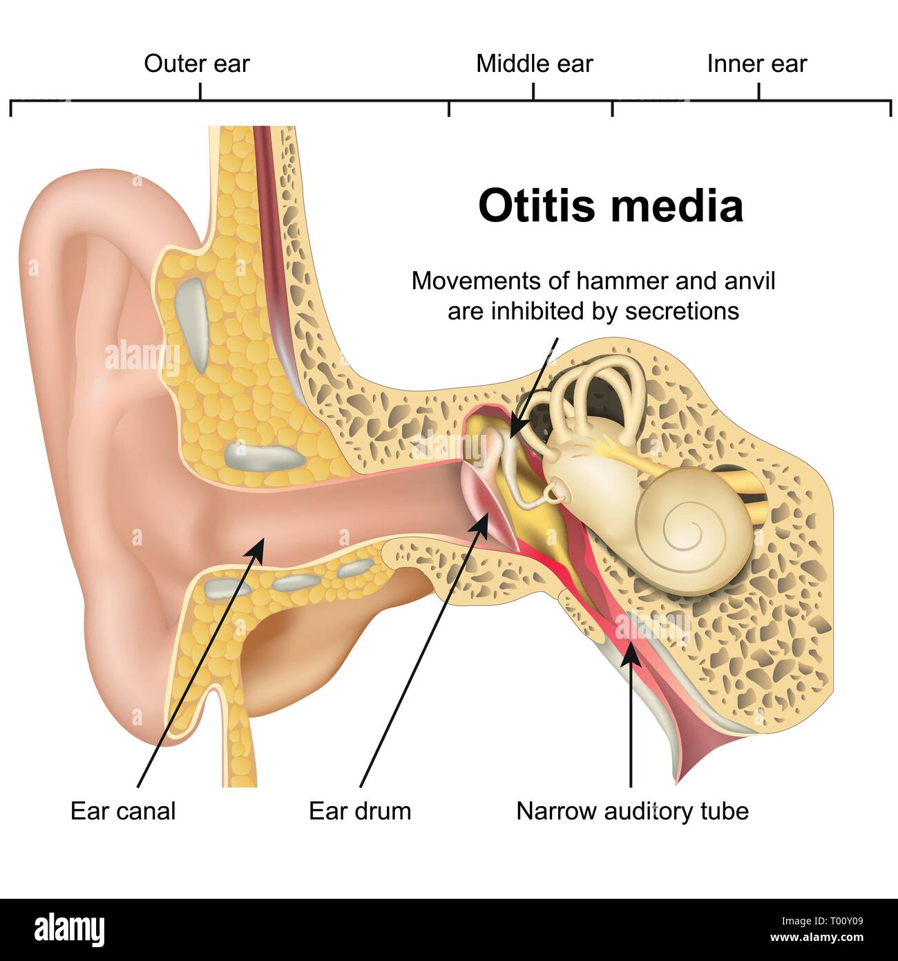 Otitis media ear disease 3d medical vector illustration on white background Stock Vector