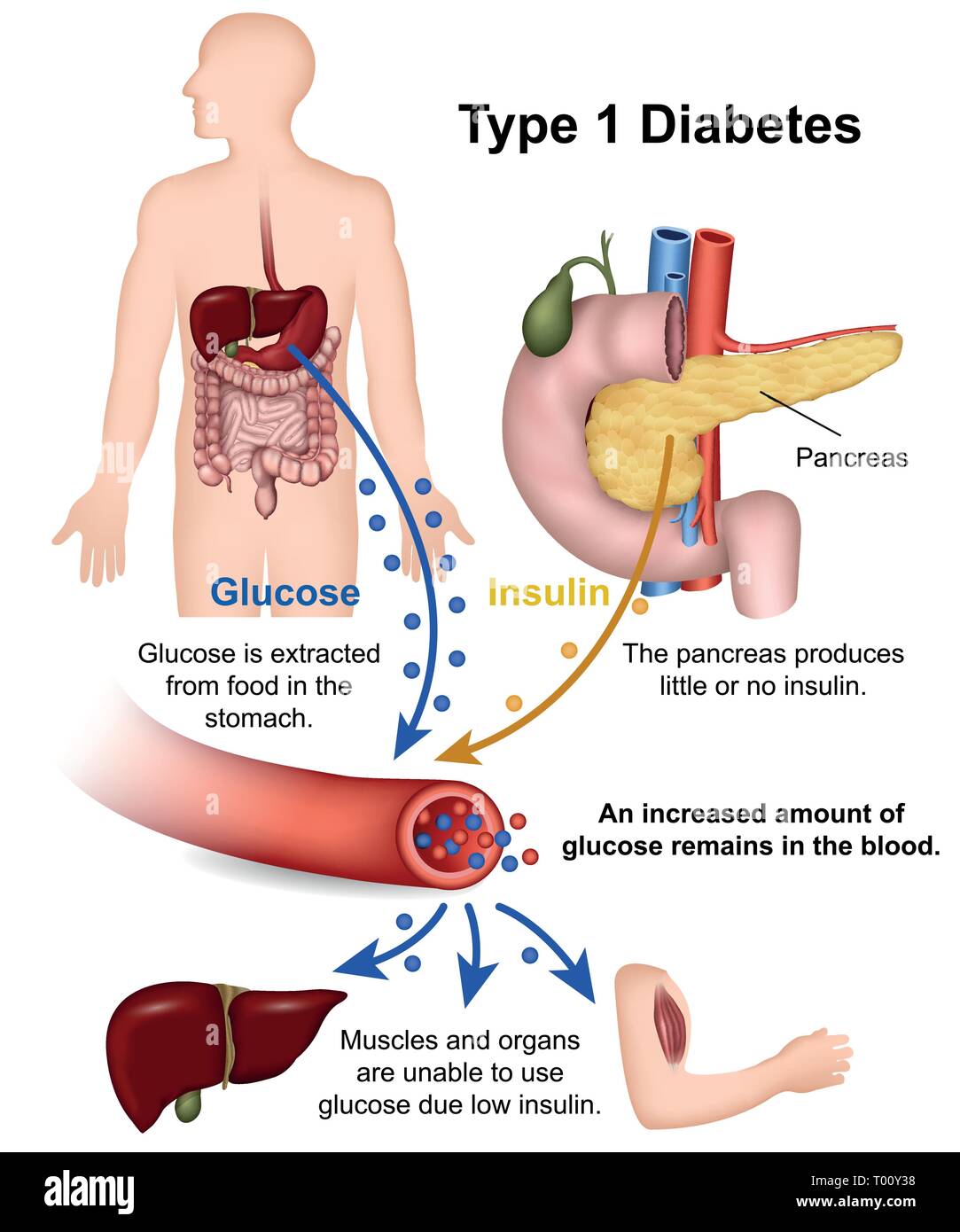 Type 1 diabetes medical vector illustration with english description Stock Vector