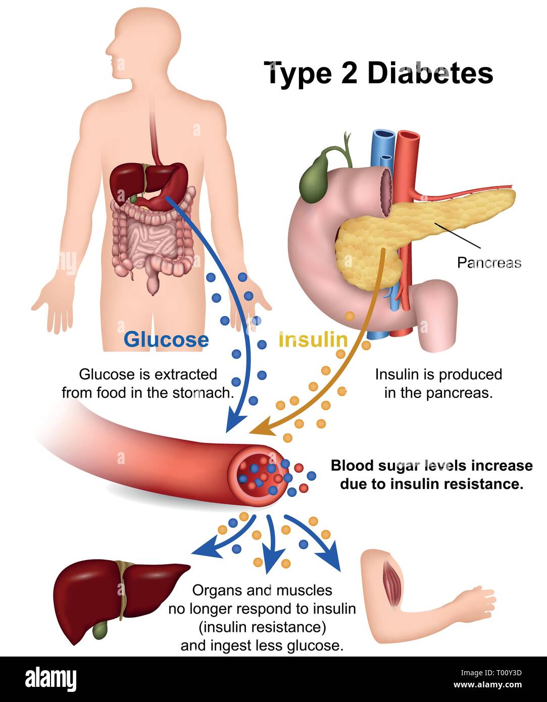 Type 2 diabetes medical vector illustration with english description Stock Vector