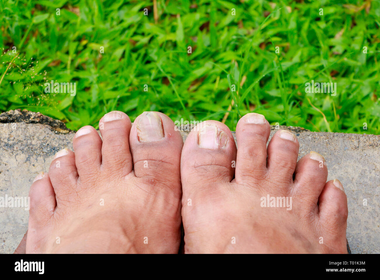 Black Toenail From Running How To Treat Runners' Toe SELF, 47 OFF