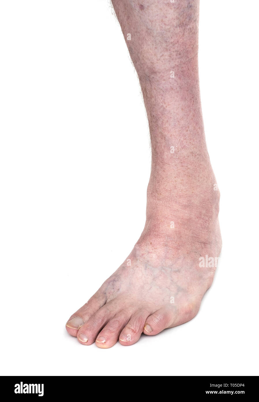 Club Foot High Resolution Stock Photography And Images Alamy